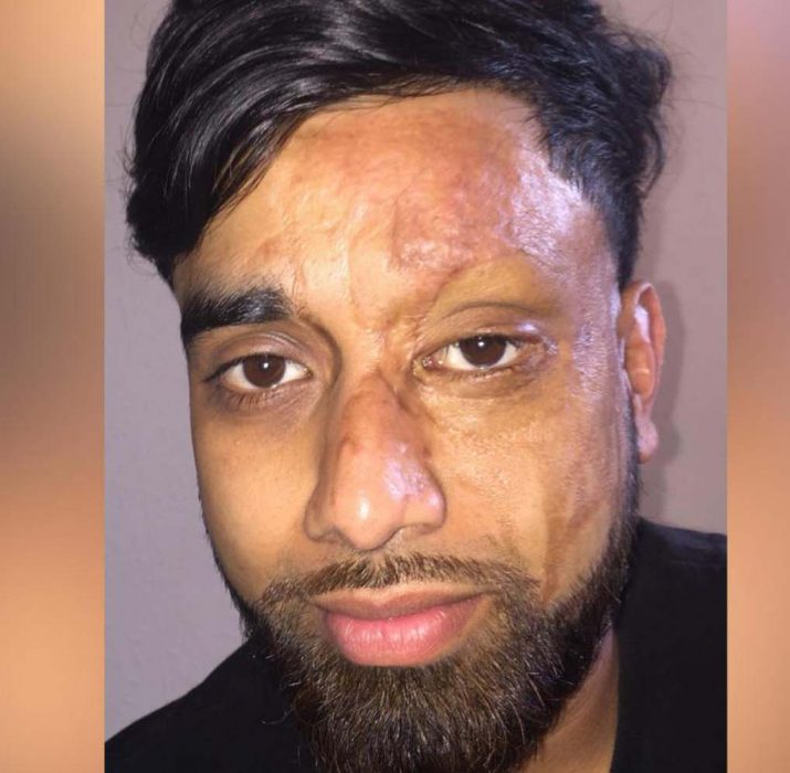 Acid attack victim: they had to cover mirrors in hospital so I couldn’t see myself