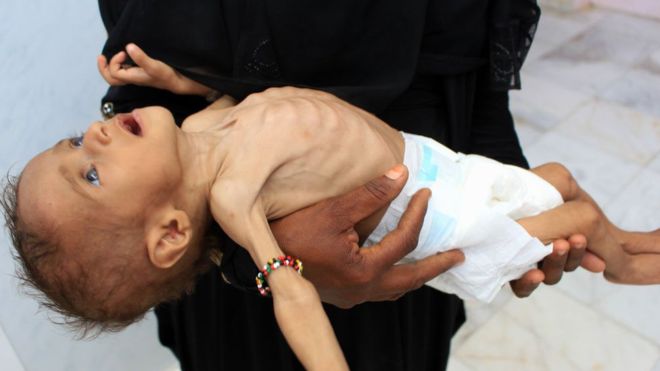 Yemen krizi: ’85 bin çocuk açlıktan öldü’