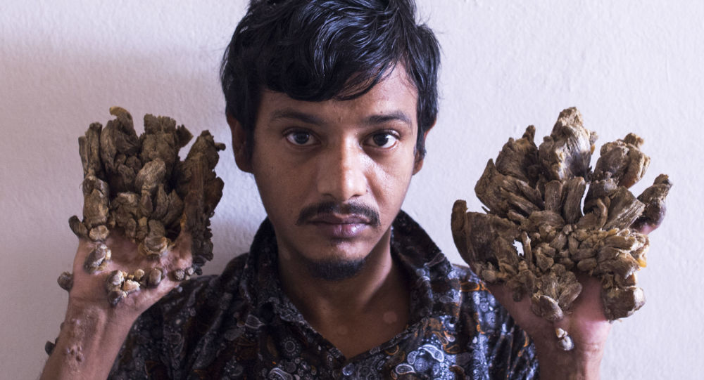 Bangladeşli ‘ağaç adam’ acısının son bulması için ellerinin kesilmesini istedi