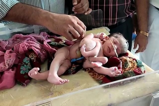 Hindistan’da dört bacaklı, üç kollu kız bebek dünyaya geldi