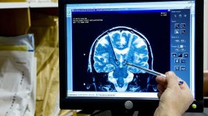 Çin’de Alzheimer için geliştirilen ilaca onay çıktı
