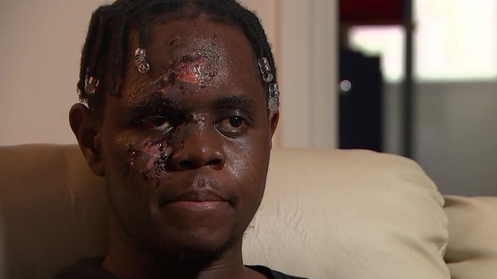 İngiltere’de ırkçı saldırıya uğrayan sağlık çalışanı: ‘Hala nefes alabildiğim için mutluyum’