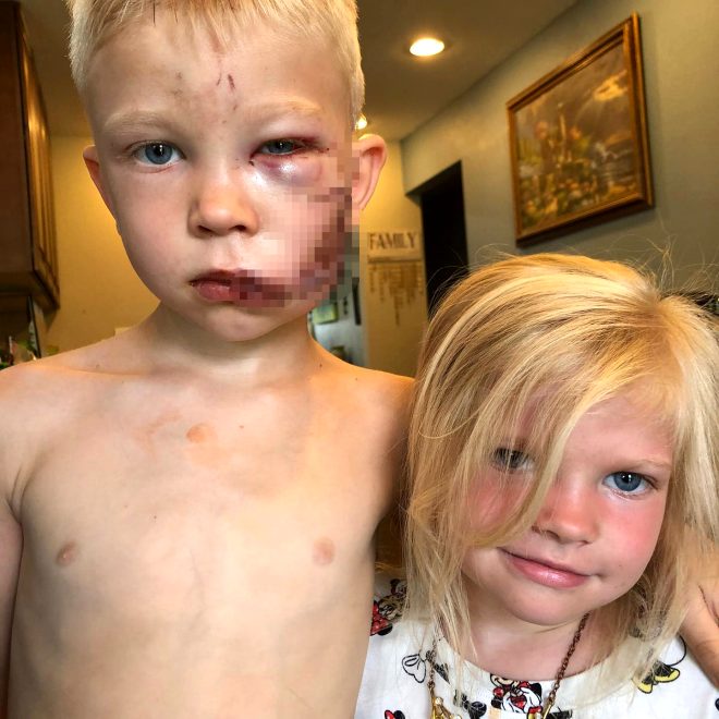 ABD’nin minik kahramanı: Kız kardeşini köpek saldırısından kurtarırken yaralandı
