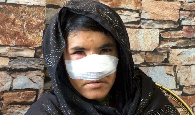 Kocası tarafından burnu kesilen Afgan kadını: Ölüm korkusuyla yıllar geçti