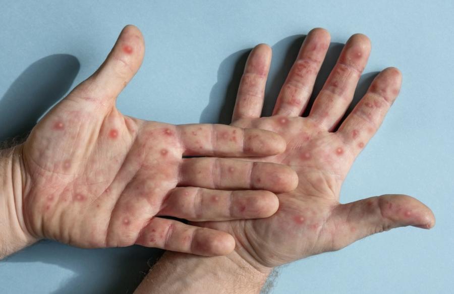 Birleşik Krallık’ta yeni tür Monkeypox tespit edildi
