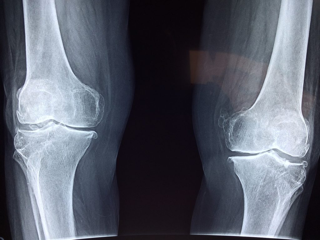 Put on a stone increases odds of knee op by a third, study claims