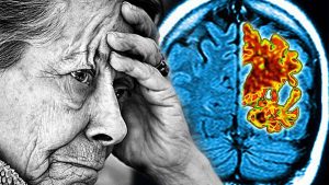 İngiltere’de Alzheimer’ı erken teşhis etmek için kan testi deneyleri yapılacak